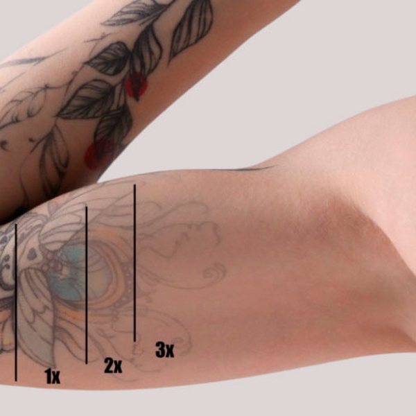 Eliminación de tatuajes con láser por sesiones