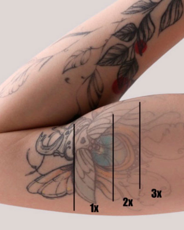 Eliminación de tatuajes