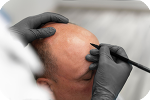 Personalización micropigmentación capilar Bilbao