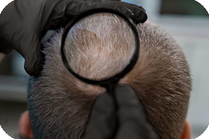 Reserva micropigmentación capilar Bilbao