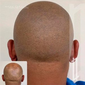 Resultado de la micropigmentación de cabeza