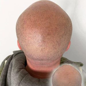 Cómo queda la micropigmentación capilar