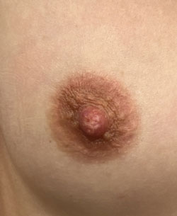 micropigmentación areolas Bilbao