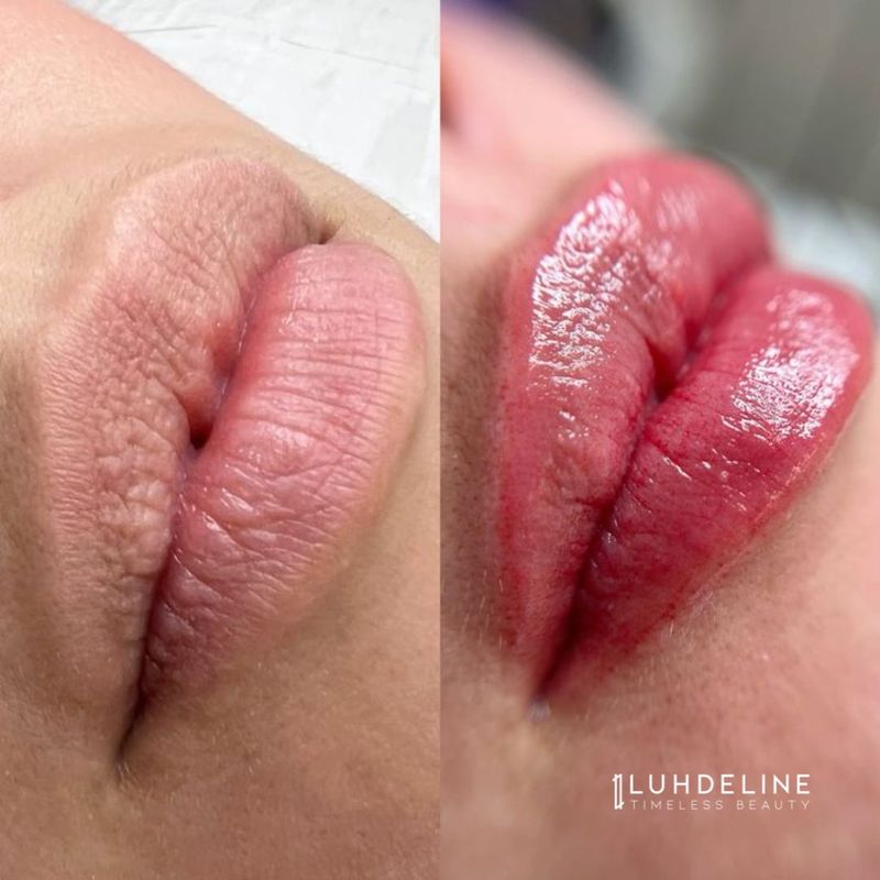 Labios antes y después de Hidra Lips